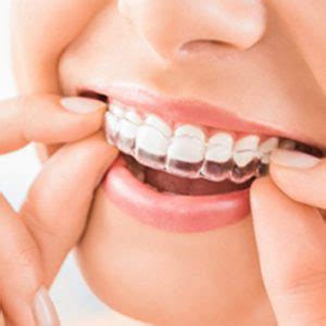 invisalign cheyenne wy